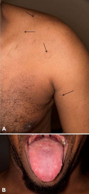 Images for DWII of lipoid proteinosis