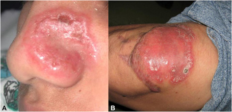 Image for recognizing cutaneous Balamuthia mandrillaris infection