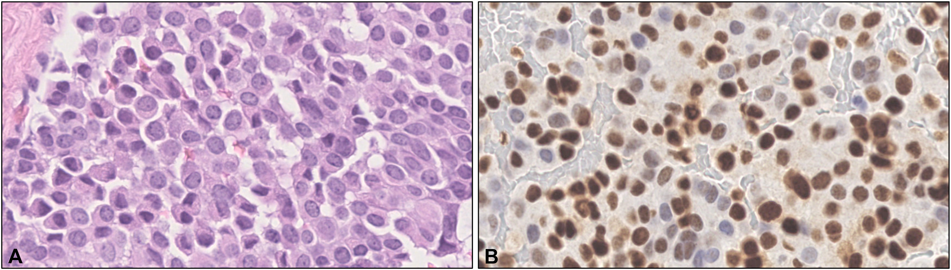The image shows eccrine mucin-producing sweat gland carcinoma (EMPSCG) routine histology (A) and immunoperoxidase staining with INSM1 (B)