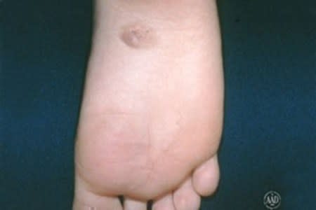 Congential mole on bottom of foot