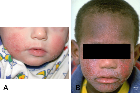 Atopic dermatitis on baby’s cheeks (A), Rash and discolored skin on boy’s face caused by atopic dermatitis (B)