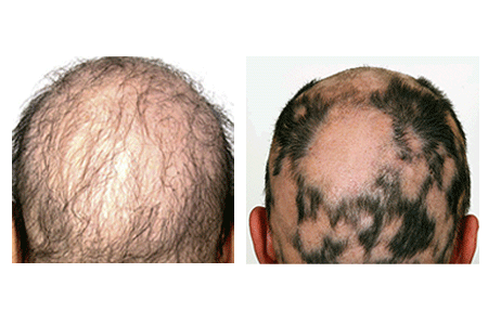 Patches of hair loss - Clinical Advisor