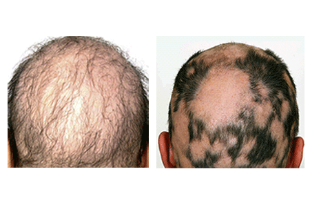 Widespread hair loss due to alopecia areata and a large bald patch and several smaller bald patches on man’s head due to alopecia areata
