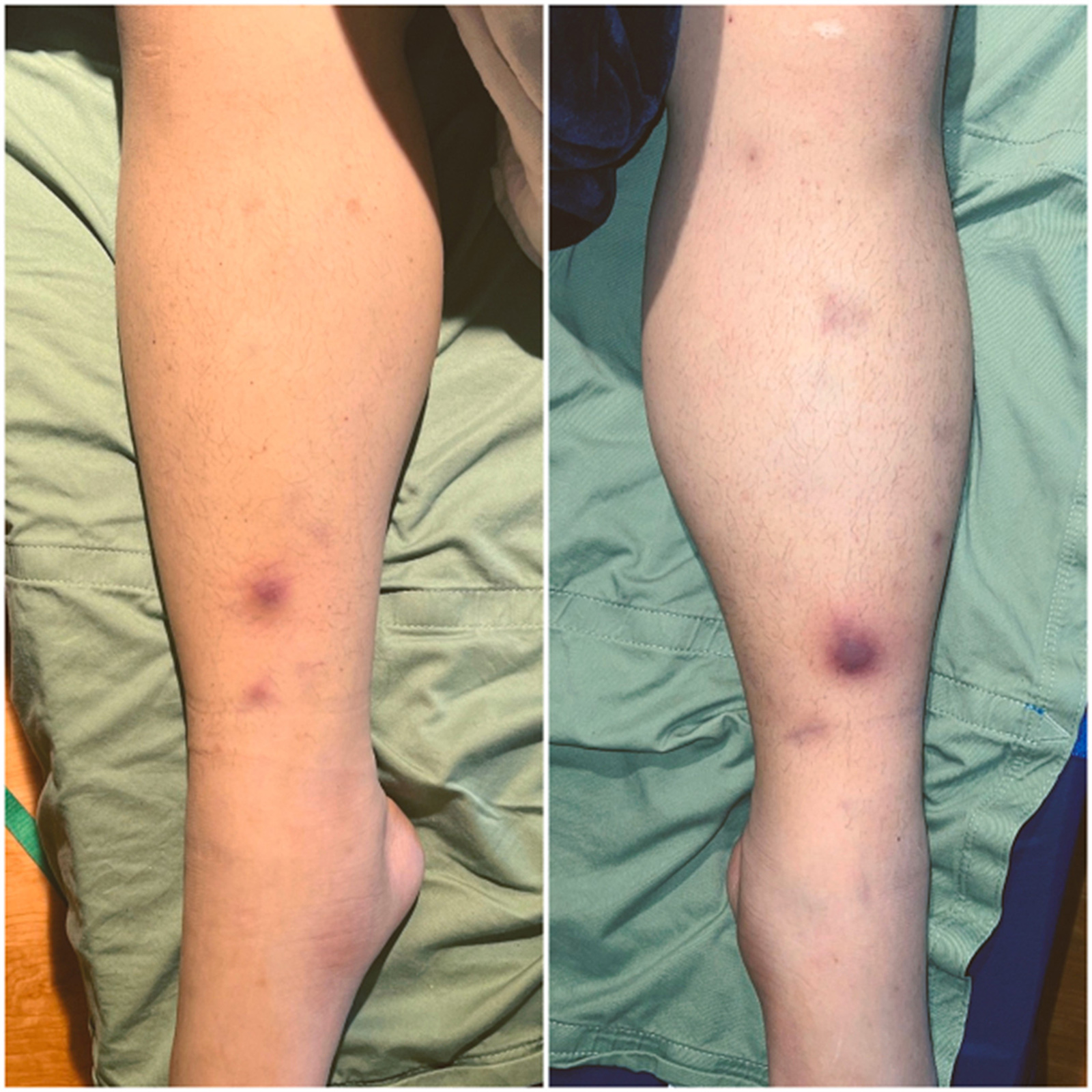 Image for DWII of Pancreatic panniculitis