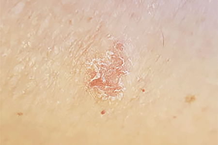 Nummular eczema on dry, dehydrated skin