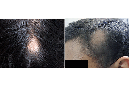 Patches of hair loss - Page 2 of 3 - Clinical Advisor