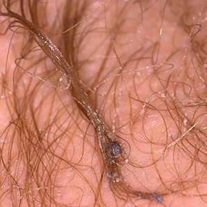 Image for DWII of trichobacteriosis