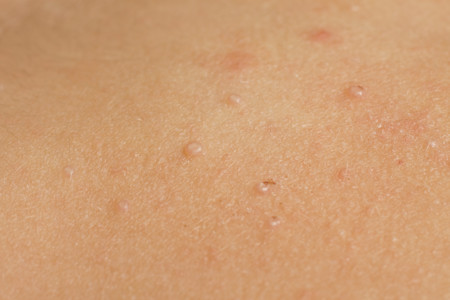 Molluscum contagiosum: Signs and symptoms