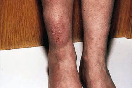 Hard and waxy lumps on discolored skin of a leg could be thyroid disease