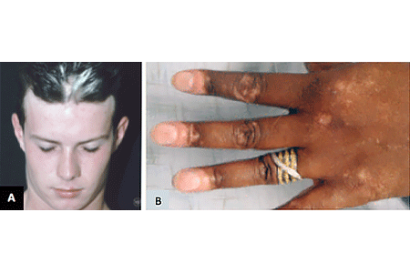 Images of people with vitiligo on scalp and hand