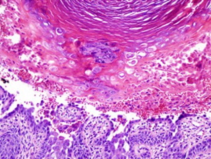 Histologic image of Darier disease for DWII