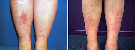 Small bumps of lichen planus merged to form a larger area called a plaque (left), lichen planus on shins (right)