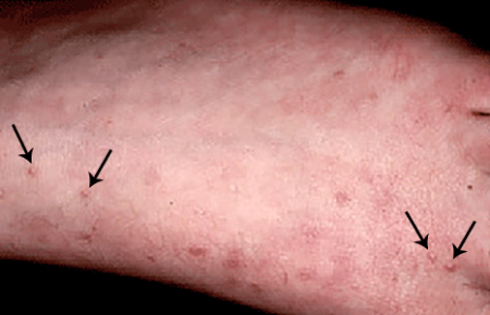  Perforating granuloma annulare on skin