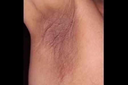 Darker, velvety skin in an armpit is a common sign of acanthosis nigricans