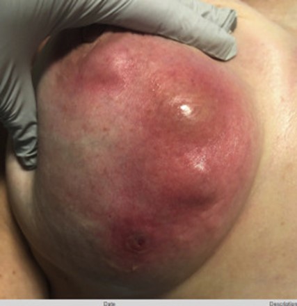 Image for DWII of idiopathic granulomatous mastitis 