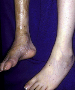 Scleroderma: Signs and symptoms