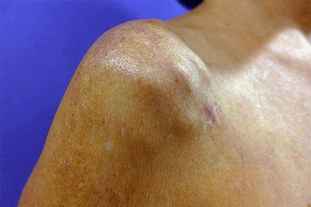 Sarcoidosis nodules deep in shoulder