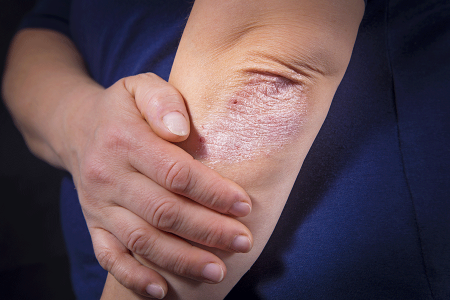 psoriasis on patient’s elbow