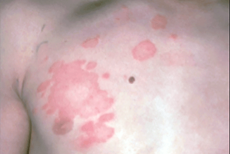 beginning stage of ringworm in humans