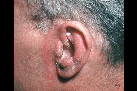 Seborrheic dermatitis rash around and inside an ear