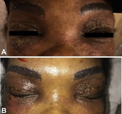 Illustration for DWII on microblading, before and after