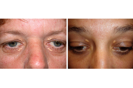 Yellowish white patches around eyelids of woman with diabetes. Yellowish orange patches above eyelids in woman with diabetes.
