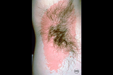Armpit rash caused by deodorant