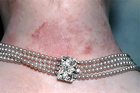 Rash caused by necklace