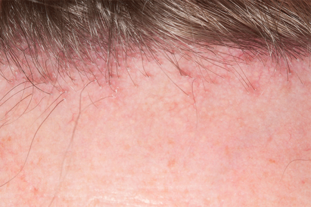 Rash of small red bumps along hairline 