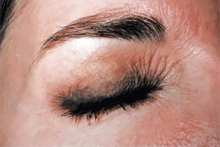Contact dermatitis around eye