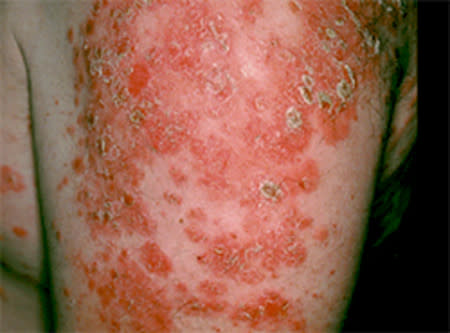 Pemphigus foliaceus blisters on the skin