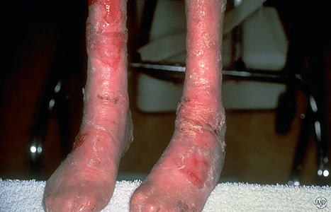 Dystrophic epidermolysis bullosa blisters on legs and feet of a child