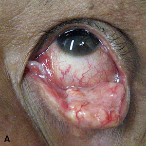 Image of sebaceous carcinoma for DWII