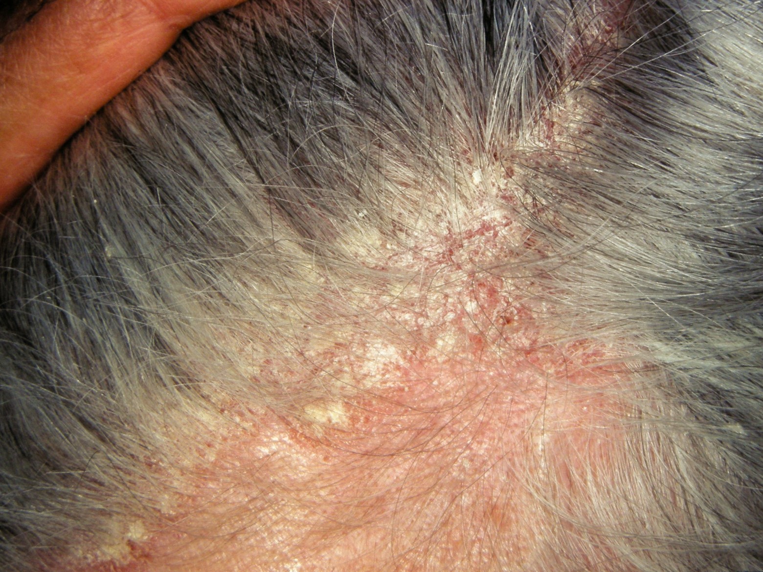 Image of a scalp showing signs of dermatitis for DWII on the relation between erectile dysfunction and chronic inflammation | American Academy of Dermatology (AAD).