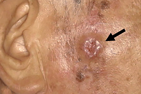 Reddish growth that looks like a sore is squamous cell skin cancer