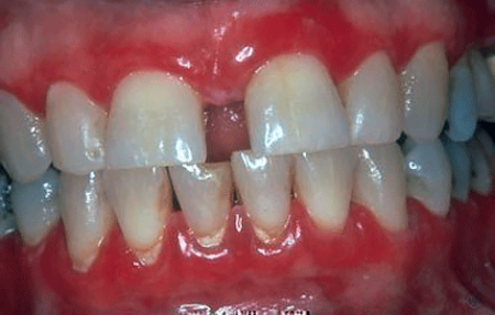 Lichen planus can cause redness and sores on the gums inside the mouth