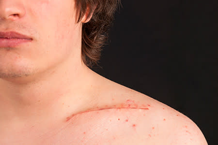 Scar on a man's shoulder