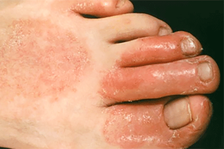 Contact dermatitis caused by shoes