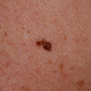 Image for DWII of a nevus for Melanocytic Pathology Assessment Tool and Hierarchy for Diagnosis (MPATH-Dx) version 2.0