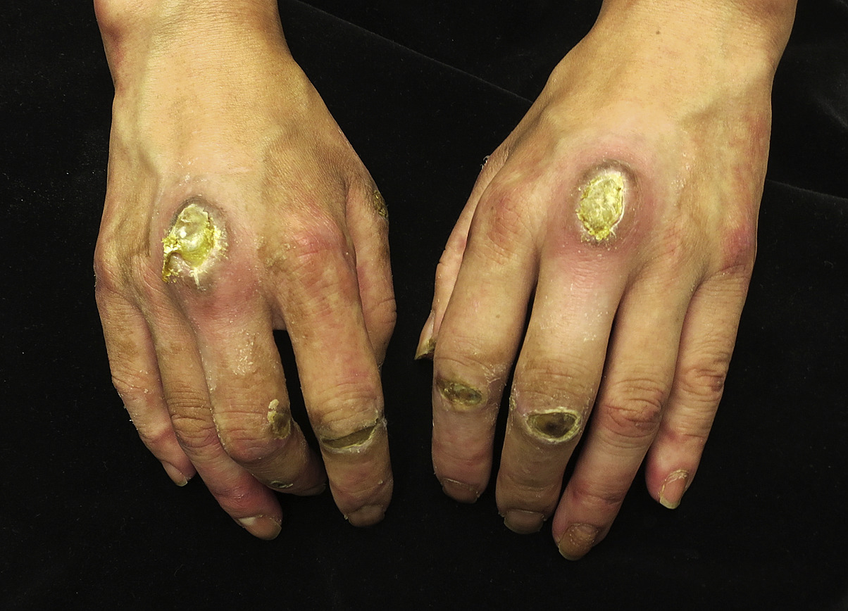 Image for DWII of dermatomyositis