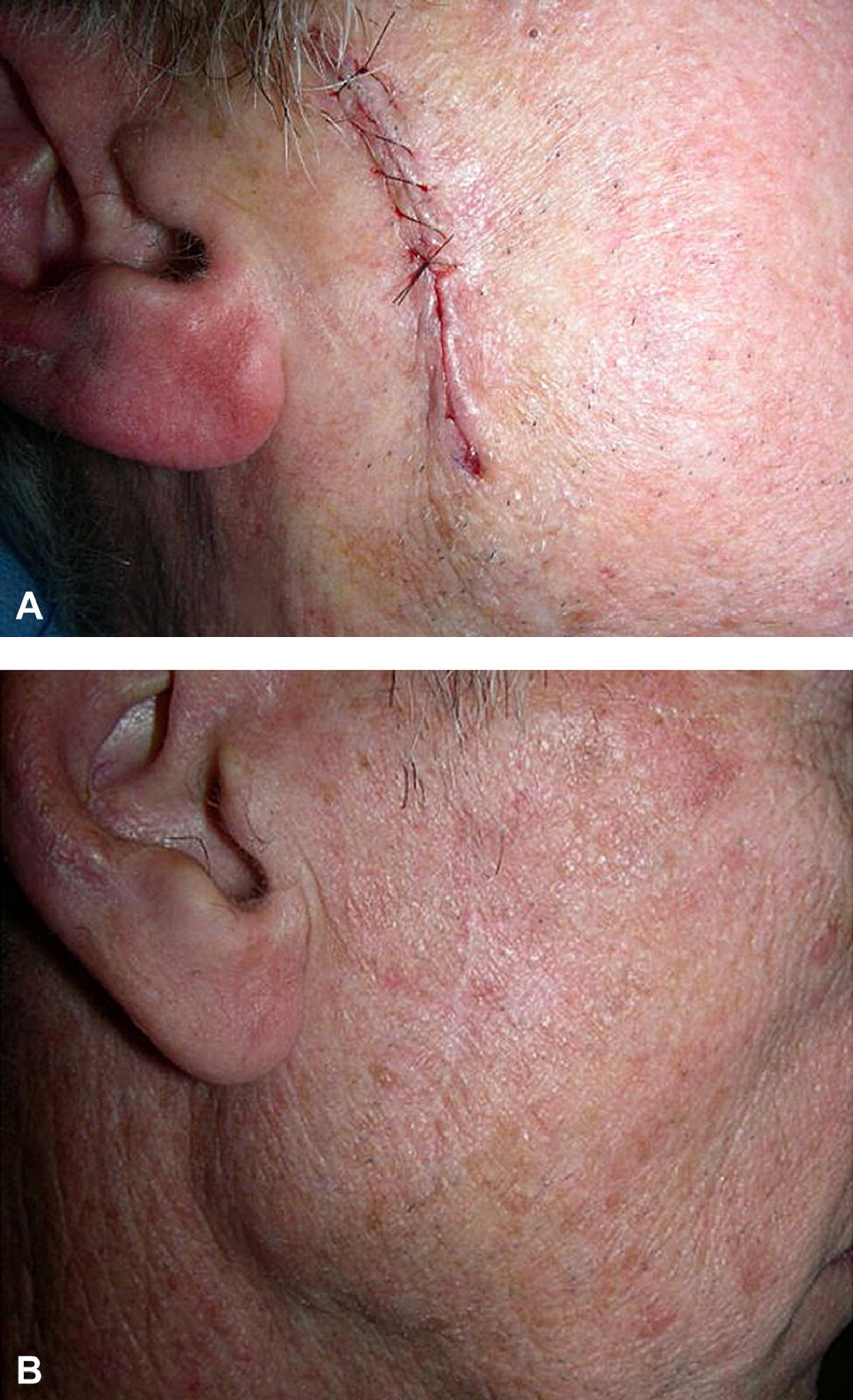 Images for DWII of a biopsy wound immediately post-operation and a second image that shows the wound after it has healed and formed a scar, on a patient with lighter skin tones