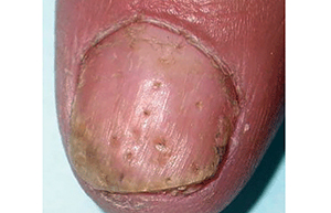 Fingernail with pits
