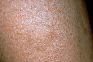 Dry skin with fish-like scales