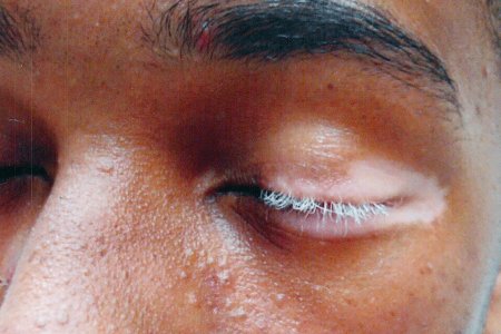 White eyelash due to vitiligo