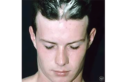 Vitiligo Who Gets And Causes