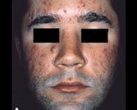 Acne nodules and cysts