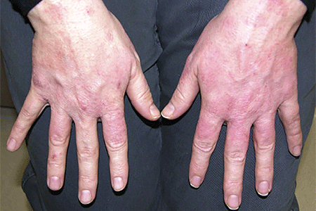 Contact dermatitis on hands