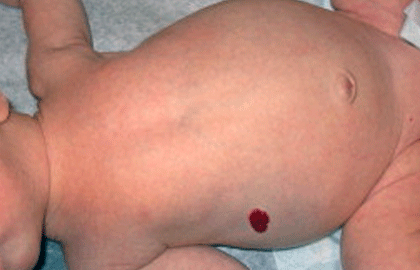 Strawberry hemangioma on baby's body