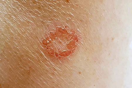 Nummular eczema flattens out as it clears