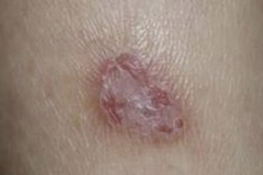 A reddish, pink scaly patch on this patient’s skin could be mistaken for a sore, but it’s squamous cell carcinoma | American Academy of Dermatology (AAD).